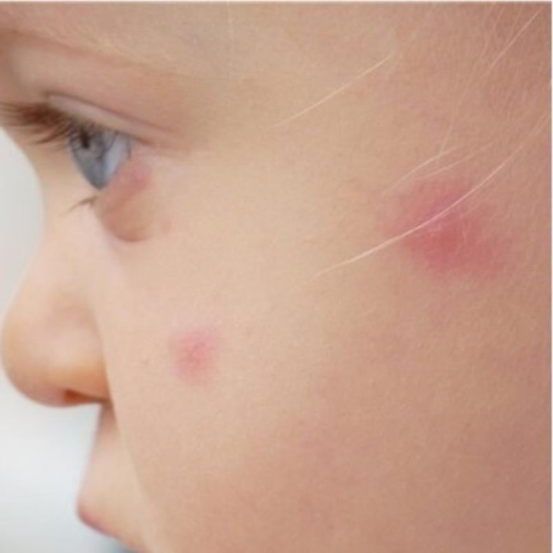 Аллергия на комариный укус у ребенка - что делать? Как лечить кулицидоз?